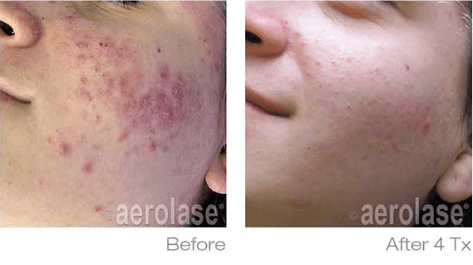 Acne Scars