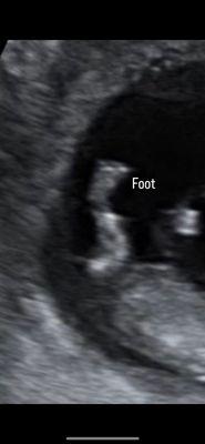 Baby foot