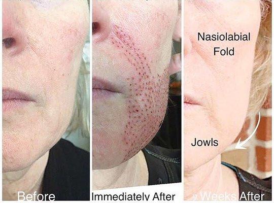 Plasma skin tightening- Nasolabial folds & Jowls