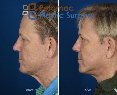 Lower face and neck lift