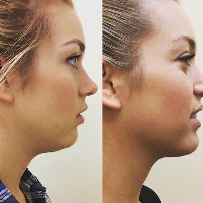 Chin Augmentation