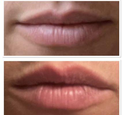 Lip reshaping