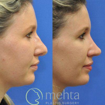 Rhinoplasty before (left) and after (right)