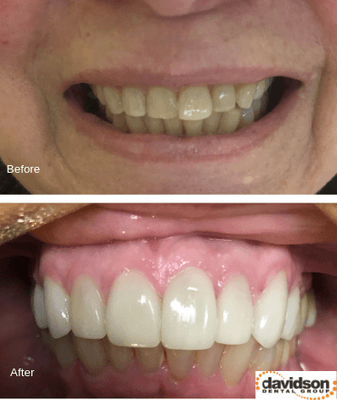 Before and after Dr. Davidson's cosmetic and restorative dentistry