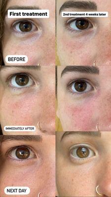 PRF under eyes treatment