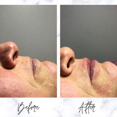 Before & After Hyaluron lip filler