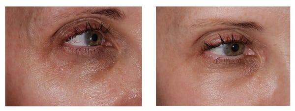 In just a few minutes, the "Madonna Lift" significantly  reduces lines, wrinkles, dark circles, and lifts the eyebrows.