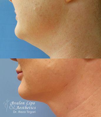 Before & After Liposuction with Dr. Tirgari - www.lipoandaesthetics.com - Neck/Chin