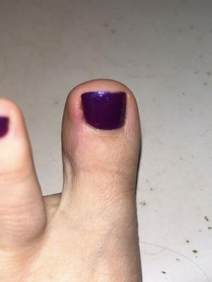 Inflamed toenail