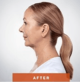 After Kybella Injections