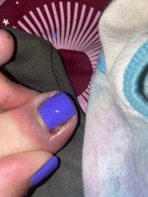 Infected nail