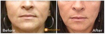 Filler by ALA Injector, Shivali Dave - before (left) and after (right)