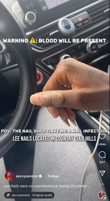 Nail infection