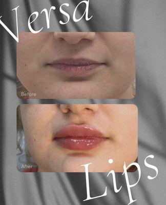 Transform your pout with Versa Lips! 
Benefits include: 
- Provides fullness, volume & hydration
- add projection and symmetry