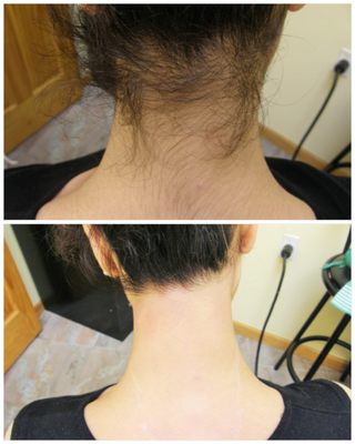 Hairline correction