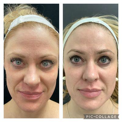 Laser Resurfacing for texture