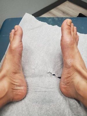 This was my athletes feet before . I had tried countless medications and over the counter powders