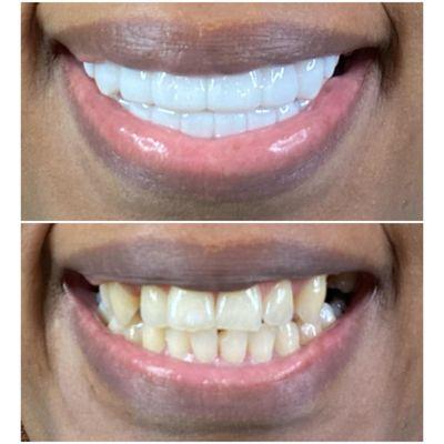 Removable Veneers USA