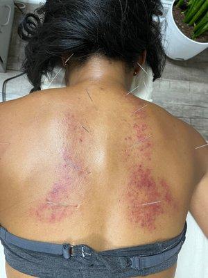 Gua sha and acupuncture