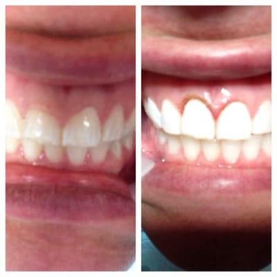 Before and after a 5 min procedure to push back my gums and expose more tooth. Making me look like I have an adult smile!