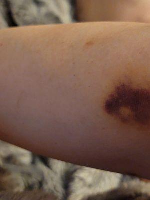 Bruise, almost 2 weeks later