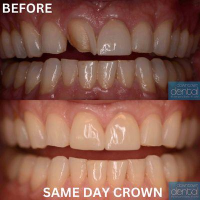 SAME DAY CROWN