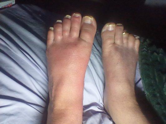 My feet from Complex Regional Pain Syndrome. Its the most painful autoimmune disease in the world.