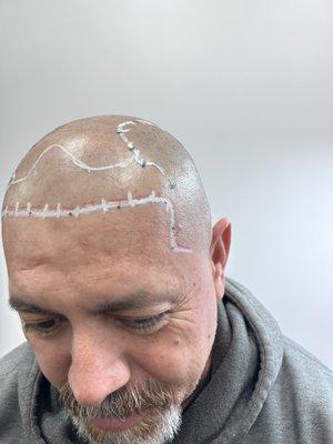 We make sure that the areas that he has growing hair we do not add the scalp micropigmentation.