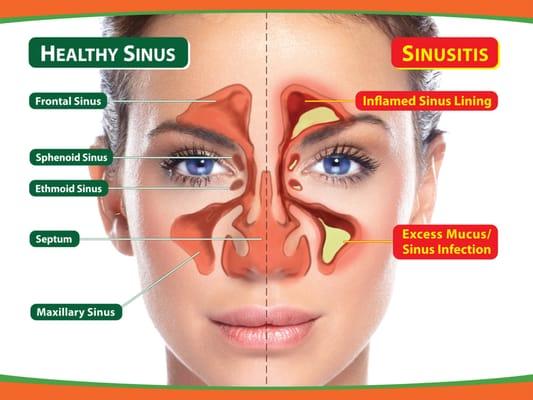 We Solve Sinus Problems