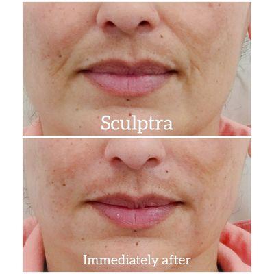 Sculptra PLLA filler on nasolabial folds