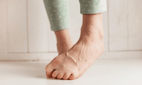 Ankle Swelling is one of the common symptom of vein disease