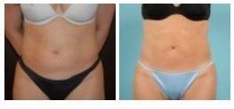 Liposuction