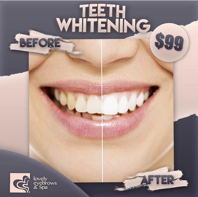 Teeth Whitening January Promo in our Miami Downtown location