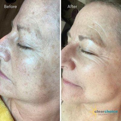 Before and After VI PEEL (chemical peel)