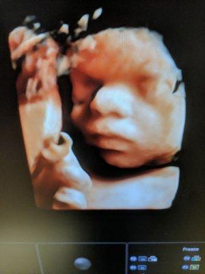 3d4d ultrasound