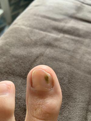 Fungus After pedicure