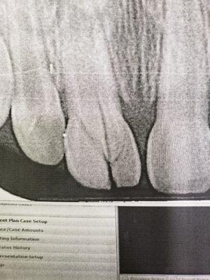 XRay of cracked tooth