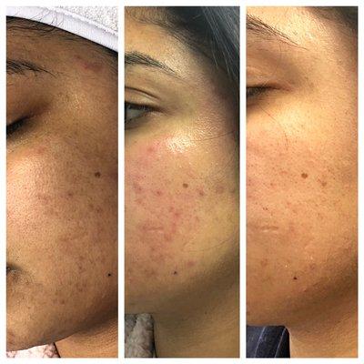 Chemical Peel