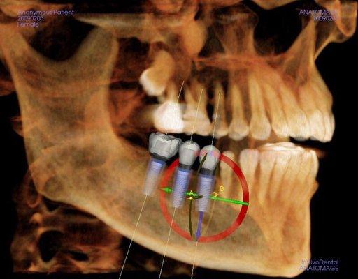 3D X-rays at our office allow for precision placement of implants.