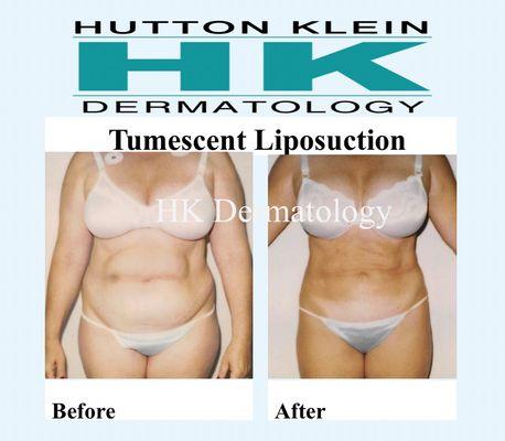 Tumescent Liposuction of the Abdomen, just in time for summer! 949-248-1632. #liposuction #dermatologist