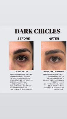 Dark Circles treatment