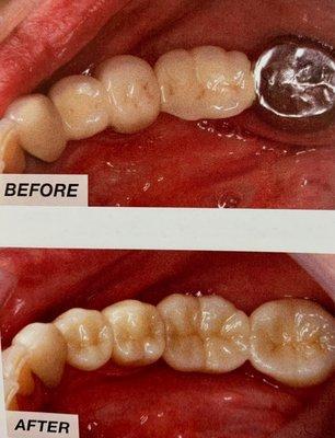 Before and after my Zirconia crown