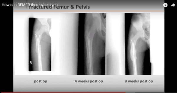 Bone fractures heal quickly using the Bemer.