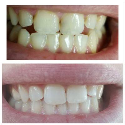 Before and After of an amazing job from Dr. Sutton.