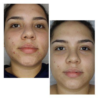 Acne clients see clear skin within 4 weeks!