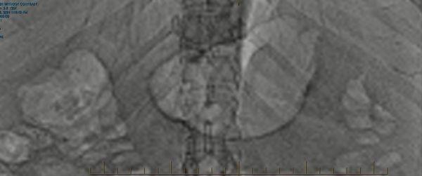 CT scan of encapsulated anomalous heterogeneous mass with varying tissue types.