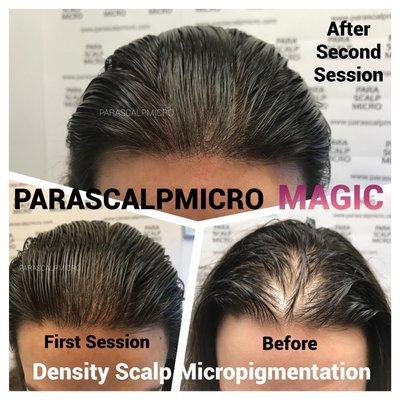 Magically fix Female Pattern Baldness, Hair Density Scalp Micropigmentation,  Nano Hair Follicle Tattoo.New York City Best Artist training