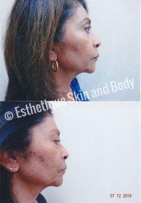 Skin tightening treatment