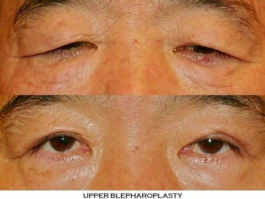 Upper Blepharoplasty performed on both eyes. 