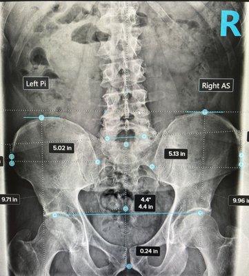 Pelvic X-Ray Analysis